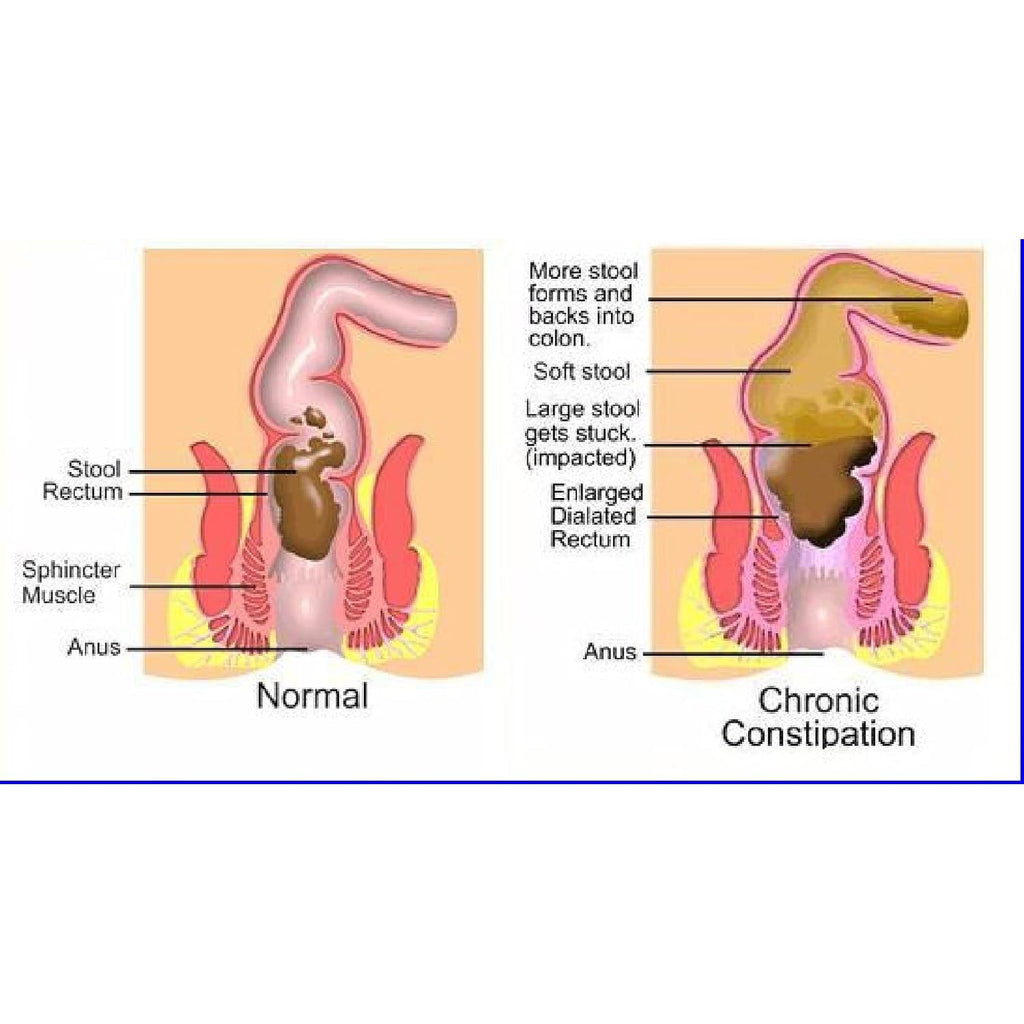 The One Minute Miracle - Miracle Oxy-Colon Cleanse - Colon Cleanser for 2 Day Cleanser