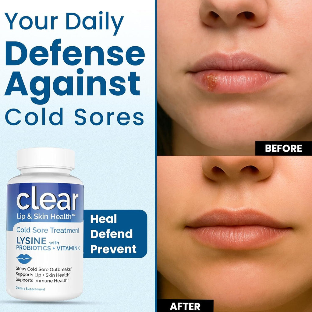 Lysine Cold Sore Treatment for Lips with Pre-Probiotics & VIT C | 1 Month Supply | Supercharged Lysine Capsules with Rhamnosus & Acidophilus for Cold Sores Relief, Skin + Gut Health & Immune Support