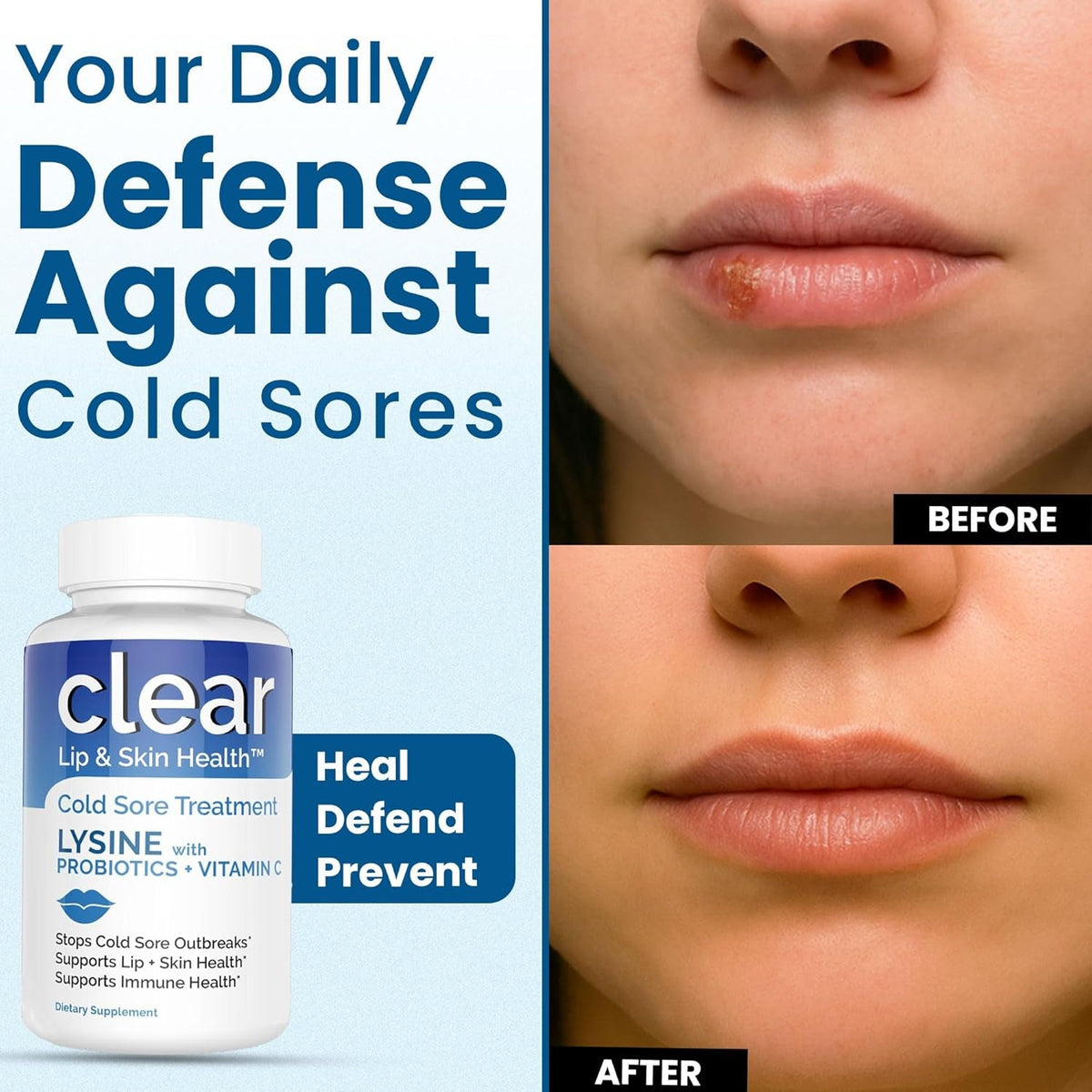 Lysine Cold Sore Treatment for Lips with Pre-Probiotics & VIT C | 1 Month Supply | Supercharged Lysine Capsules with Rhamnosus & Acidophilus for Cold Sores Relief, Skin + Gut Health & Immune Support
