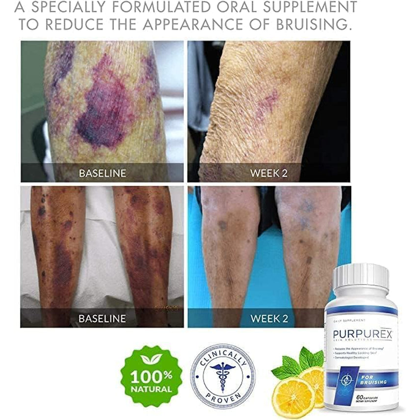 Dietary Supplement for Bruising (30-Day Supply)