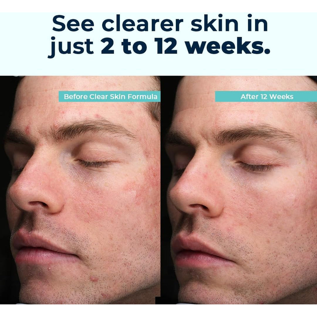 Vitamedica Clear Skin Vitamin Formula | Noncystic Acne Supplement for Skin Clearing | Clear Complexion for Women and Men | Vitamins A, C, E, Selenium, Chromium, and Zinc for Skin Health | 60 Count