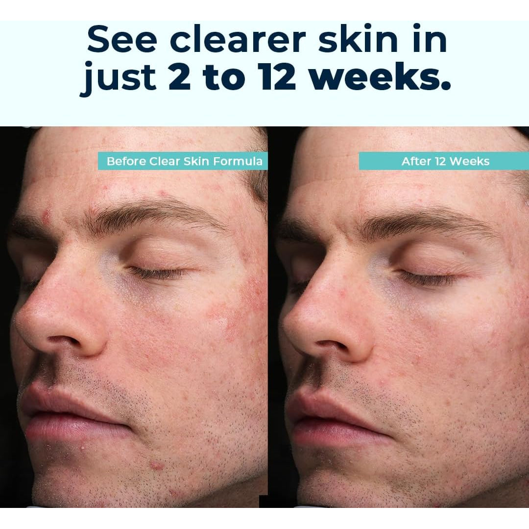 Vitamedica Clear Skin Vitamin Formula | Noncystic Acne Supplement for Skin Clearing | Clear Complexion for Women and Men | Vitamins A, C, E, Selenium, Chromium, and Zinc for Skin Health | 60 Count