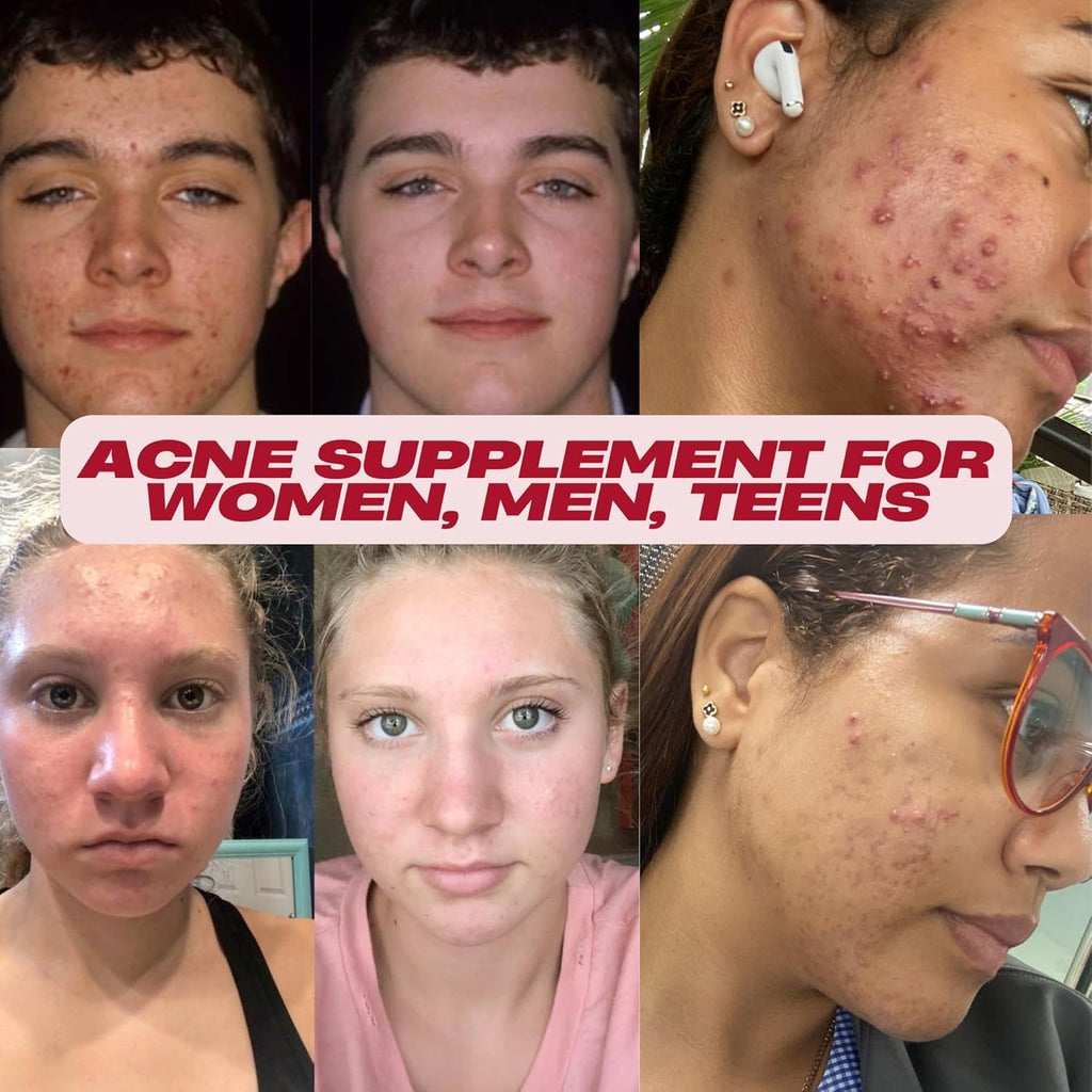 Acnetame Acne Pills- Vitamin Supplements for Acne Treatment- Natural Clear Skin from Hormonal Cystic Pimples- Oily Skin Vitamins Pill for Women, Teen, Men, & Adults 60 Tablets