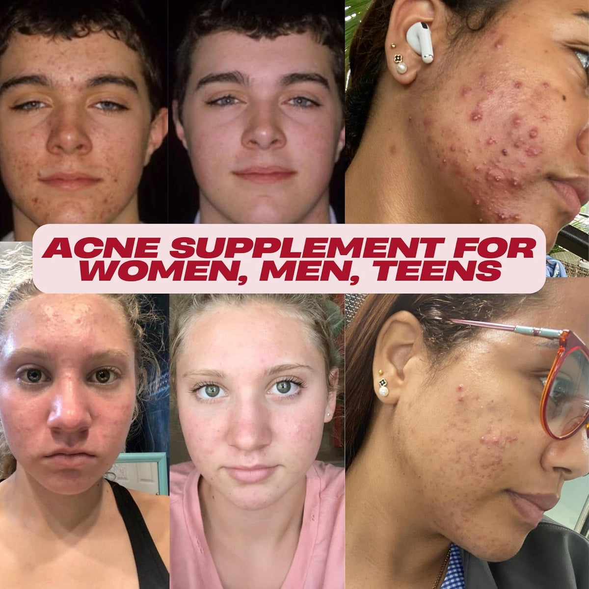 Acnetame Acne Pills- Vitamin Supplements for Acne Treatment- Natural Clear Skin from Hormonal Cystic Pimples- Oily Skin Vitamins Pill for Women, Teen, Men, & Adults 60 Tablets